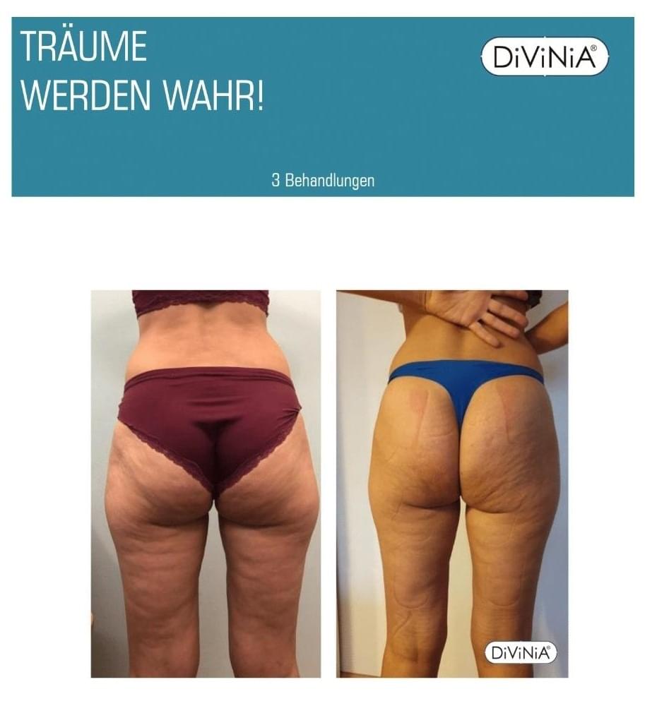 Vorher-Nachher-Ergebnis einer Body-Reset-Behandlung im Körpergefühl Dresden