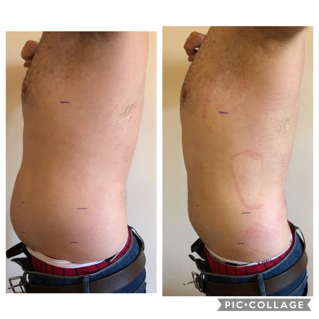 Vorher-Nachher-Ergebnis einer Körperbehandlung im Körpergefühl Dresden
